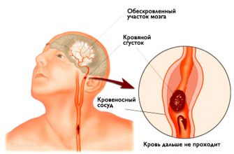 ИНСУЛЬТ: Запомните всего 3 первых шага, чтобы спасти себе и близким жизнь!