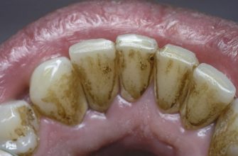 10 простых способов легко удалить зубной камень без визита к зубному врачу!