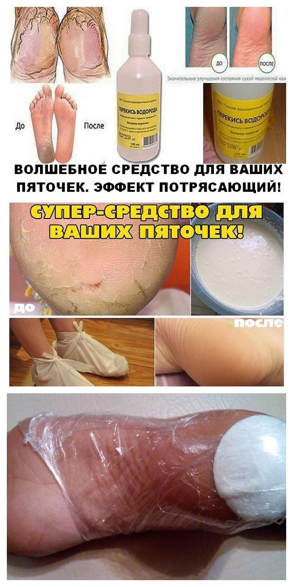 ВОЛШЕБНОЕ СРЕДСТВО ДЛЯ ВАШИХ ПЯТОЧЕК. ЭФФЕКТ ПОТРЯСАЮЩИЙ!