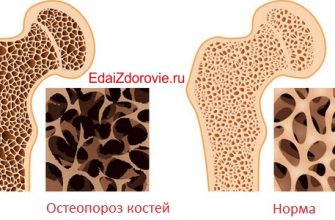 Как восстановить костную ткань