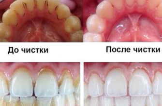 Как удалить зубной налет без визита к стоматологу