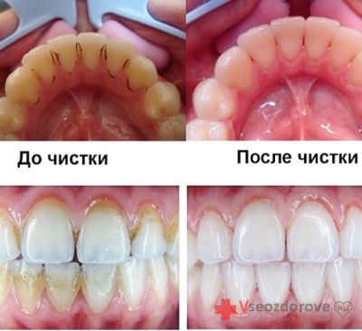 Как удалить зубной налет без визита к стоматологу