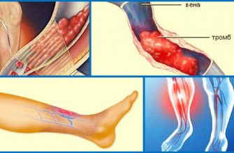 ТРОМБОЗ ГЛУБОКИХ ВЕН — 8 СИМПТОМОВ, КОТОРЫЕ НУЖНО ВЫУЧИТЬ НАИЗУСТЬ