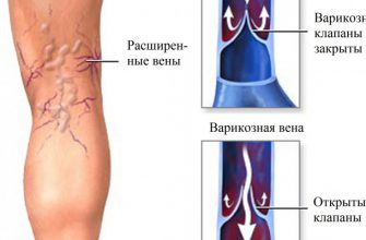НАЙДЕН ПРИРОДНЫЙ СПОСОБ ЛЕЧЕНИЯ ВАРИКОЗНОГО РАСШИРЕНИЯ ВЕН!
